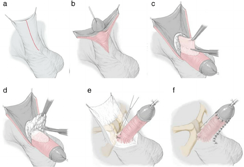 Ligamentotomie zur Vergrößerung des Penis